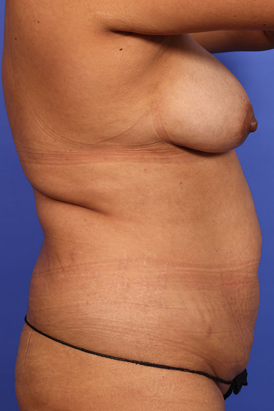 Tummy Tuck Before & After Image