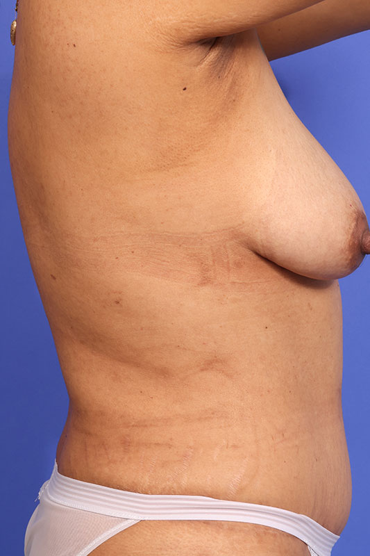 Abdominoplasty (Tummy Tuck) Before & After Image