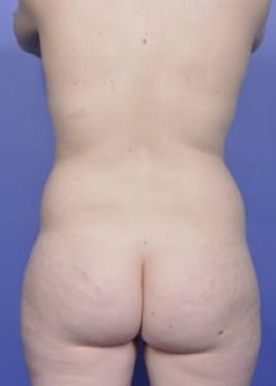 Vaser® 4D Lipo Before & After Image