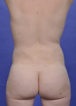 Vaser® 4D Lipo Before & After Image