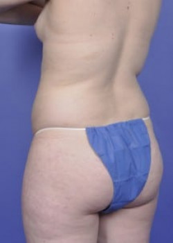 Vaser® 4D Lipo Before & After Image