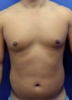 Vaser® 4D Lipo Before & After Image