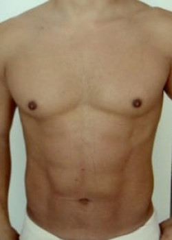 Vaser® 4D Lipo Before & After Image