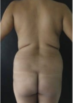 Vaser® 4D Lipo Before & After Image