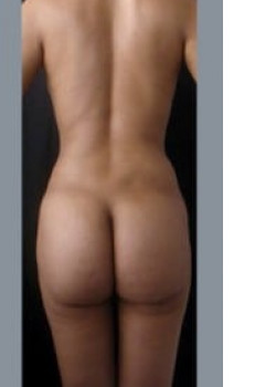 Vaser® 4D Lipo Before & After Image