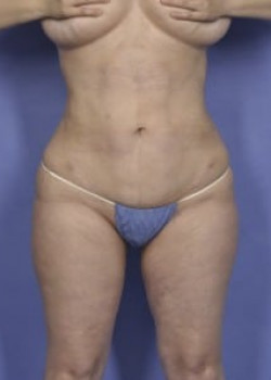 Vaser® 4D Lipo Before & After Image