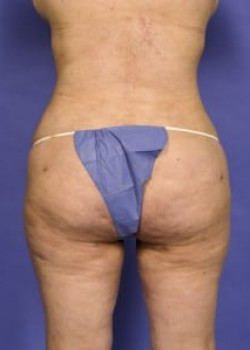 Vaser® 4D Lipo Before & After Image