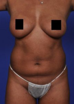 Vaser® 4D Lipo Before & After Image