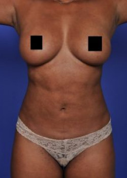 Vaser® 4D Lipo Before & After Image