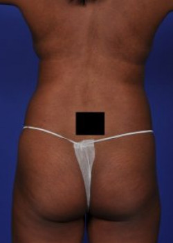 Vaser® 4D Lipo Before & After Image