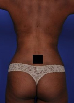 Vaser® 4D Lipo Before & After Image