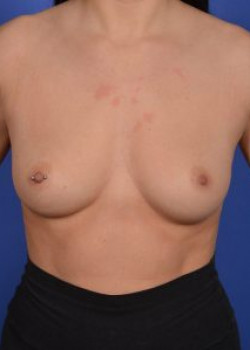 Breast Augmentation Before & After Image