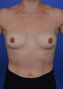 Breast Augmentation Before & After Image