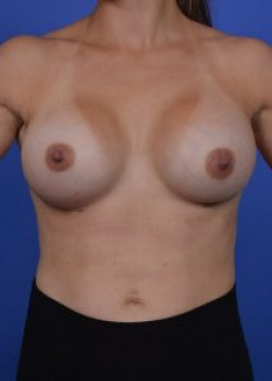 Breast Augmentation Before & After Image