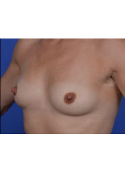 Breast Augmentation Before & After Image