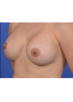 Breast Augmentation Before & After Image