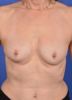 Breast Augmentation Before & After Image