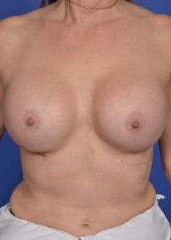 Breast Augmentation Before & After Image