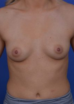 Breast Augmentation Before & After Image