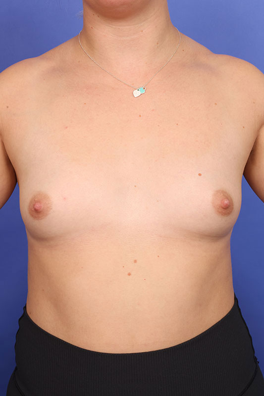 Breast Augmentation Before & After Image