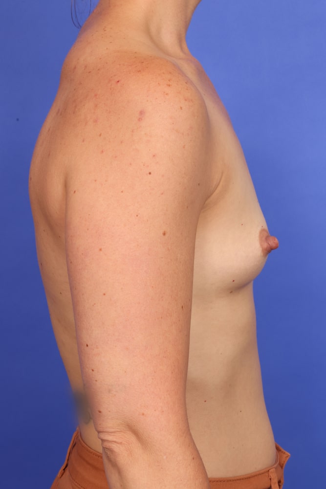 Breast Augmentation Before & After Image