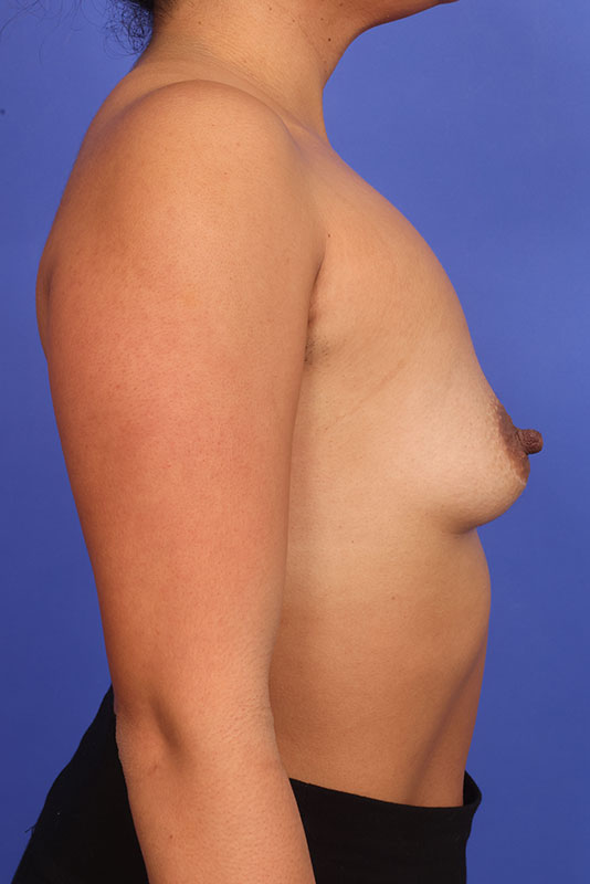 Breast Augmentation Before & After Image