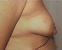 Breast Lift Before & After Image