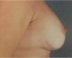 Breast Lift Before & After Image