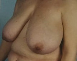 Breast Lift Before & After Image