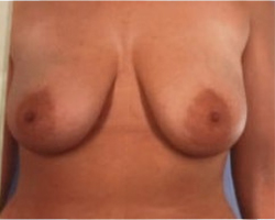 Breast Lift Before & After Image