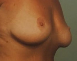 Breast Lift Before & After Image