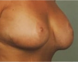 Breast Lift Before & After Image