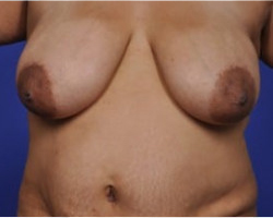 Breast Lift Before & After Image