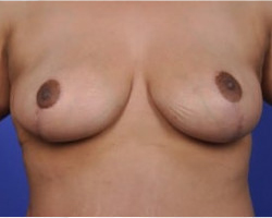 Breast Lift Before & After Image