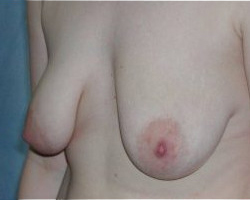 Breast Lift Before & After Image