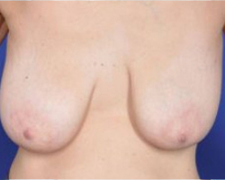 Breast Lift Before & After Image