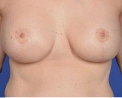 Breast Lift Before & After Image