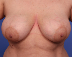 Breast Lift Before & After Image