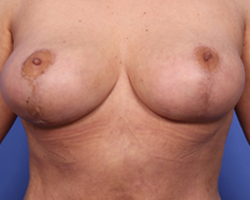 Breast Lift Before & After Image