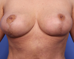 Breast Lift Before & After Image