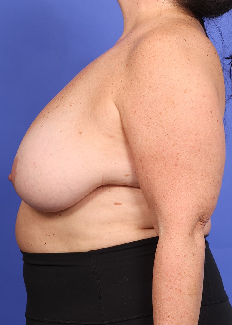 Breast Lift Before & After Image