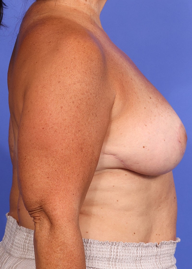 Breast Lift Before & After Image