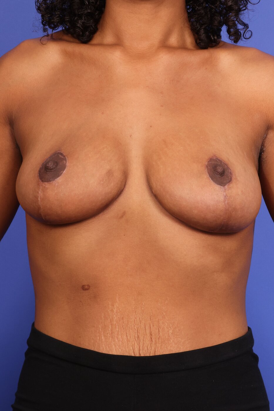Breast Lift Before & After Image