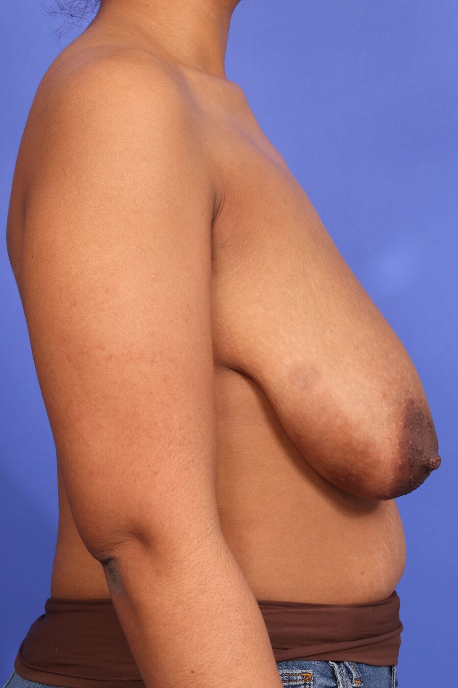 Breast Lift Before & After Image