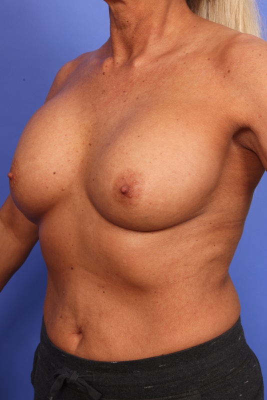 Corrective Breast Surgery Before & After Image