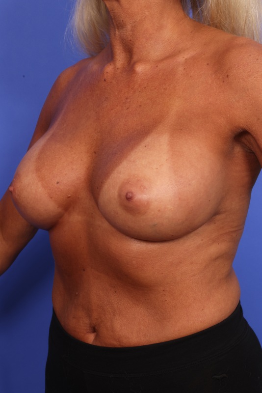 Corrective Breast Surgery Before & After Image