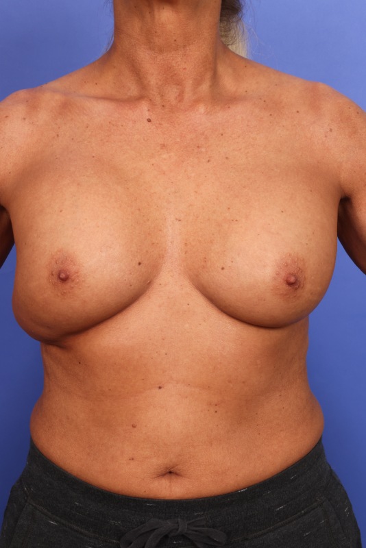 Corrective Breast Surgery Before & After Image