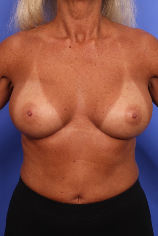 Corrective Breast Surgery Before & After Image