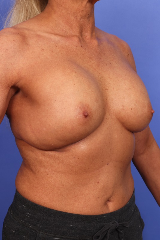 Corrective Breast Surgery Before & After Image