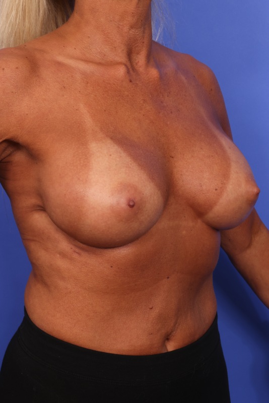 Corrective Breast Surgery Before & After Image